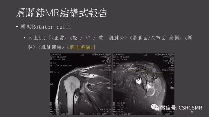 影像PPT - 【PPT】肩关节MRI的结构式评估-33