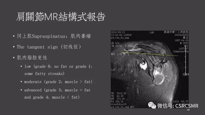 影像PPT - 【PPT】肩关节MRI的结构式评估-34