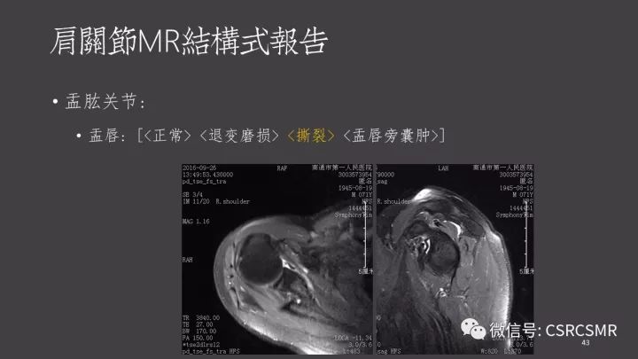 影像PPT - 【PPT】肩关节MRI的结构式评估-43
