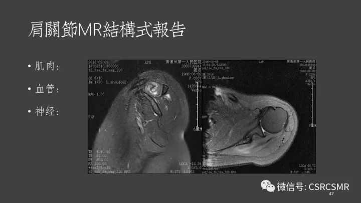 影像PPT - 【PPT】肩关节MRI的结构式评估-47