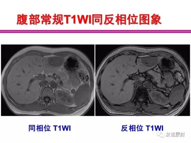 影像PPT - 【PPT】腹部脏器影像解剖及CT、MRI读片原则-14