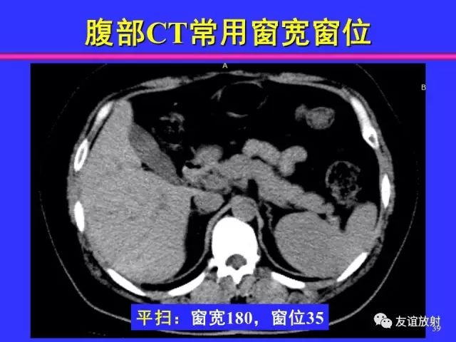 影像PPT - 【PPT】腹部脏器影像解剖及CT、MRI读片原则-39