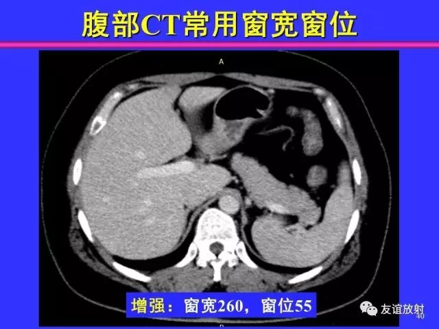 影像PPT - 【PPT】腹部脏器影像解剖及CT、MRI读片原则-40
