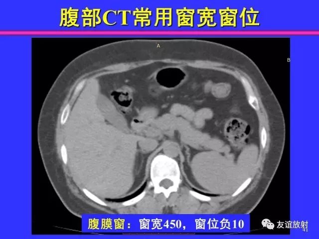 影像PPT - 【PPT】腹部脏器影像解剖及CT、MRI读片原则-41