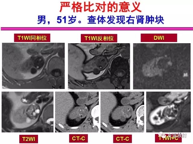 影像PPT - 【PPT】腹部脏器影像解剖及CT、MRI读片原则-44