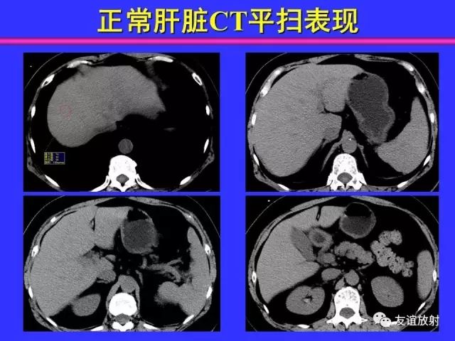 影像PPT - 【PPT】腹部脏器影像解剖及CT、MRI读片原则-52