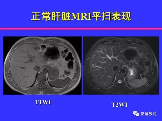 影像PPT - 【PPT】腹部脏器影像解剖及CT、MRI读片原则-54