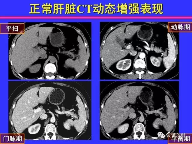 影像PPT - 【PPT】腹部脏器影像解剖及CT、MRI读片原则-56