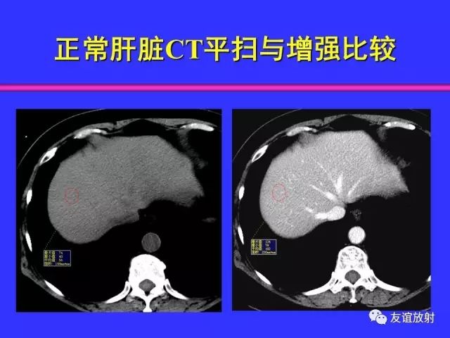 影像PPT - 【PPT】腹部脏器影像解剖及CT、MRI读片原则-57