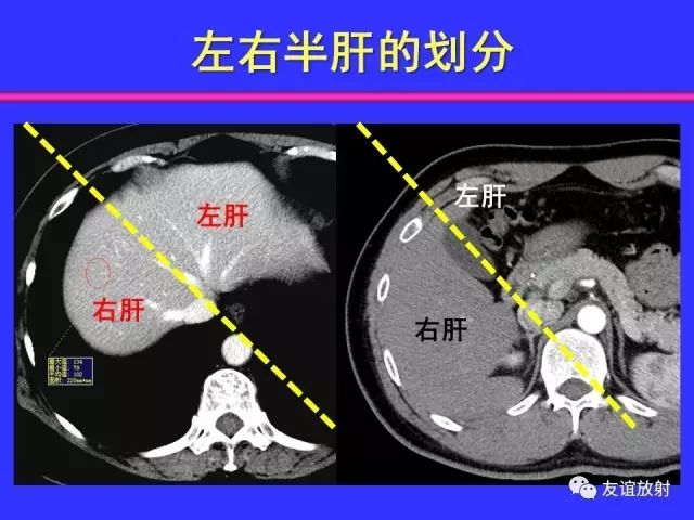 影像PPT - 【PPT】腹部脏器影像解剖及CT、MRI读片原则-62