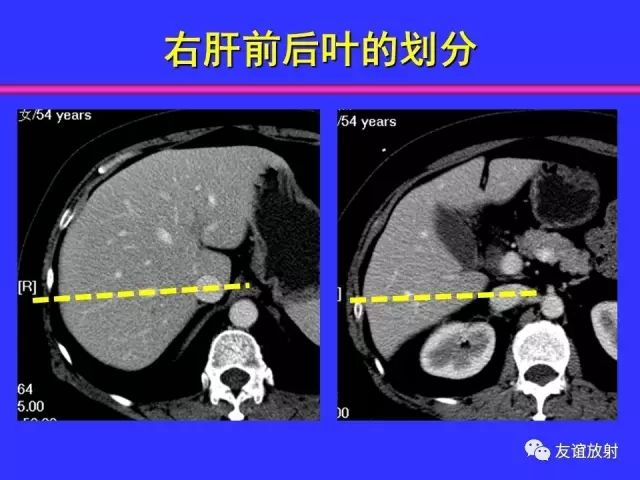 影像PPT - 【PPT】腹部脏器影像解剖及CT、MRI读片原则-65