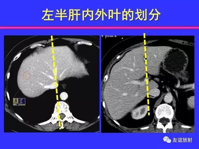 影像PPT - 【PPT】腹部脏器影像解剖及CT、MRI读片原则-68