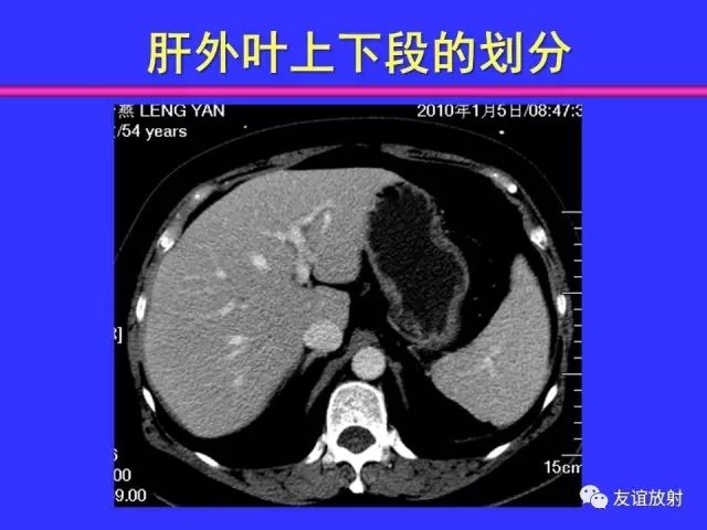 影像PPT - 【PPT】腹部脏器影像解剖及CT、MRI读片原则-69