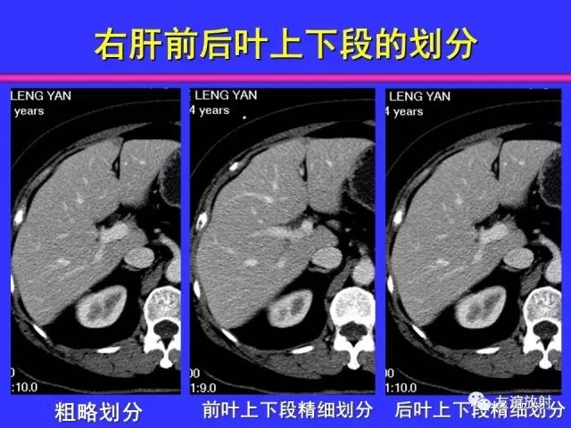 影像PPT - 【PPT】腹部脏器影像解剖及CT、MRI读片原则-66