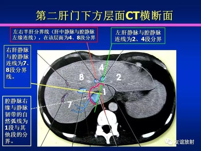 影像PPT - 【PPT】腹部脏器影像解剖及CT、MRI读片原则-70