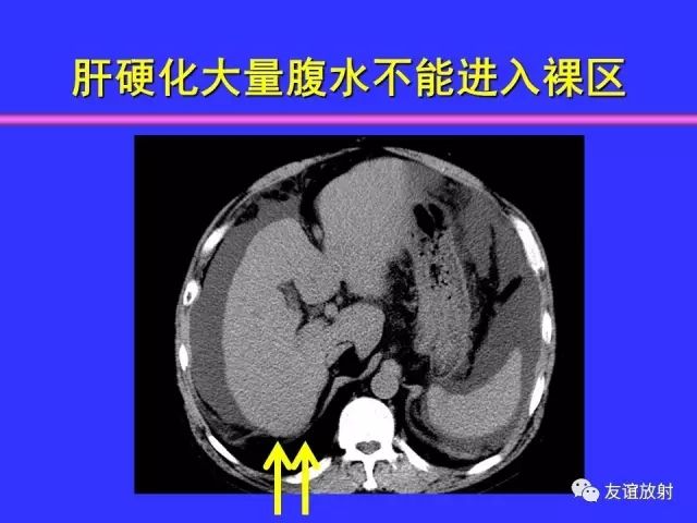 影像PPT - 【PPT】腹部脏器影像解剖及CT、MRI读片原则-74