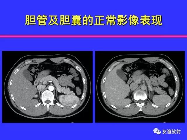 影像PPT - 【PPT】腹部脏器影像解剖及CT、MRI读片原则-76