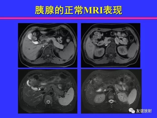 影像PPT - 【PPT】腹部脏器影像解剖及CT、MRI读片原则-81