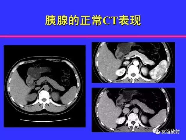 影像PPT - 【PPT】腹部脏器影像解剖及CT、MRI读片原则-80