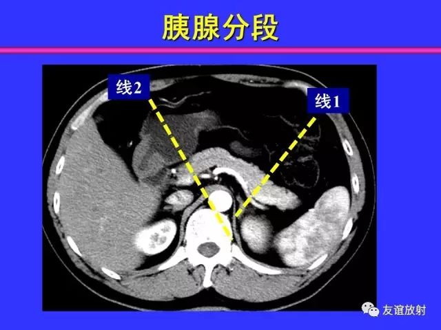 影像PPT - 【PPT】腹部脏器影像解剖及CT、MRI读片原则-84