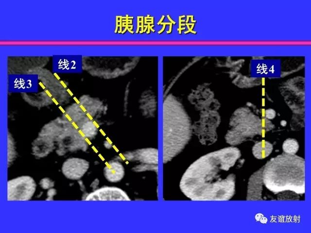 影像PPT - 【PPT】腹部脏器影像解剖及CT、MRI读片原则-85