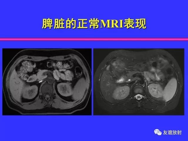影像PPT - 【PPT】腹部脏器影像解剖及CT、MRI读片原则-89