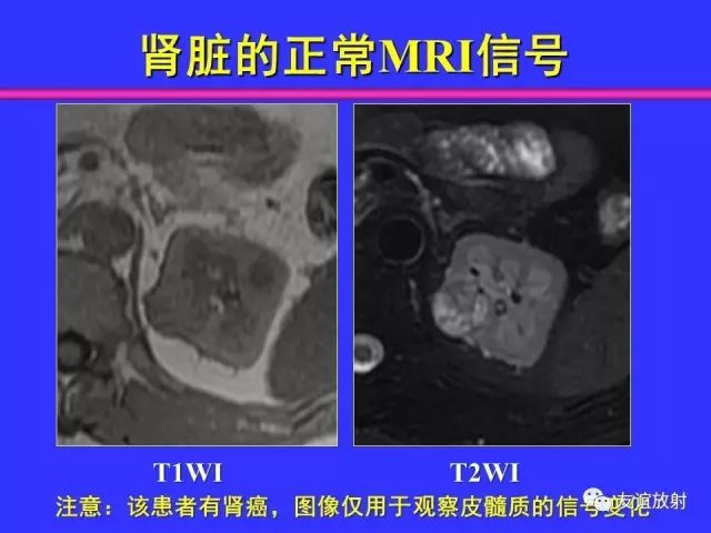 影像PPT - 【PPT】腹部脏器影像解剖及CT、MRI读片原则-94