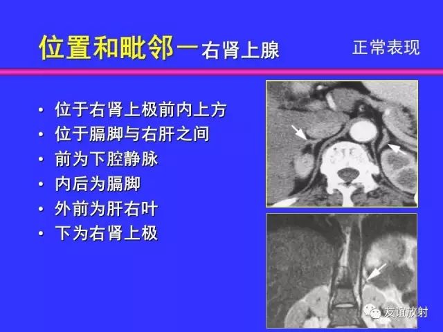 影像PPT - 【PPT】腹部脏器影像解剖及CT、MRI读片原则-99