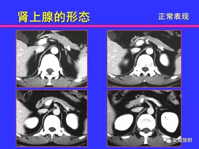 影像PPT - 【PPT】腹部脏器影像解剖及CT、MRI读片原则-104