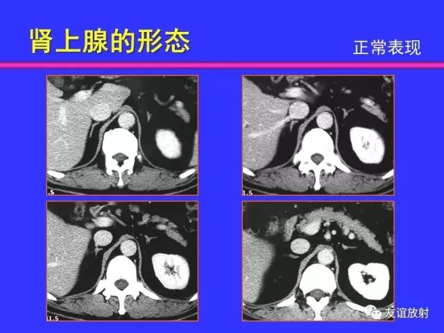 影像PPT - 【PPT】腹部脏器影像解剖及CT、MRI读片原则-105