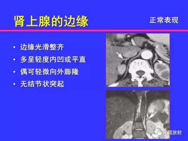 影像PPT - 【PPT】腹部脏器影像解剖及CT、MRI读片原则-106