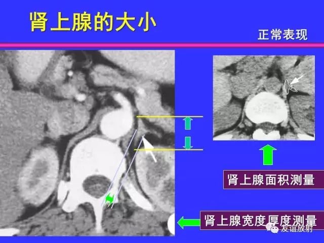 影像PPT - 【PPT】腹部脏器影像解剖及CT、MRI读片原则-111