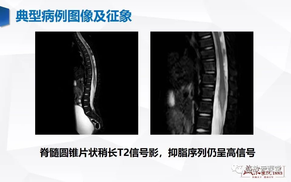 影像PPT - 【PPT】脊髓外伤-5
