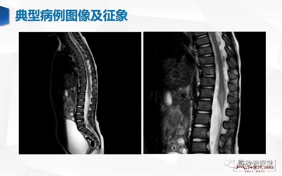 影像PPT - 【PPT】脊髓外伤-4