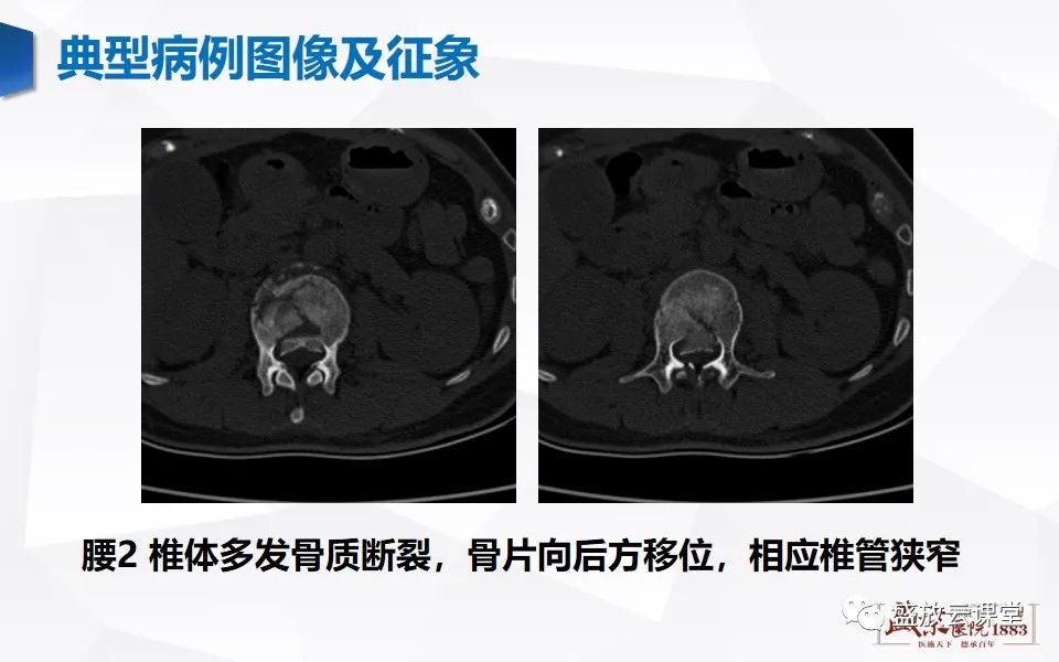 影像PPT - 【PPT】脊髓外伤-9