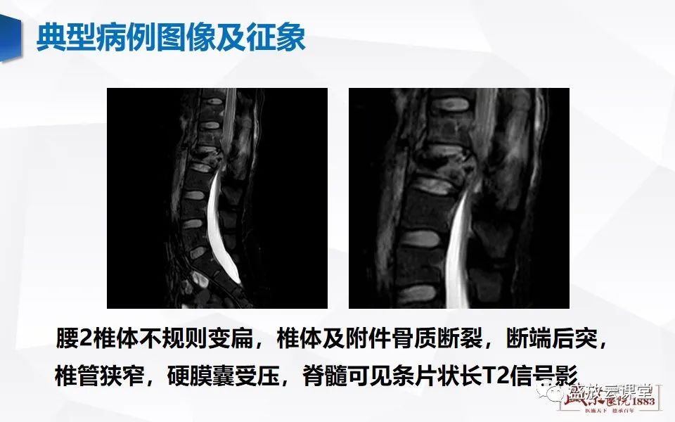 影像PPT - 【PPT】脊髓外伤-12