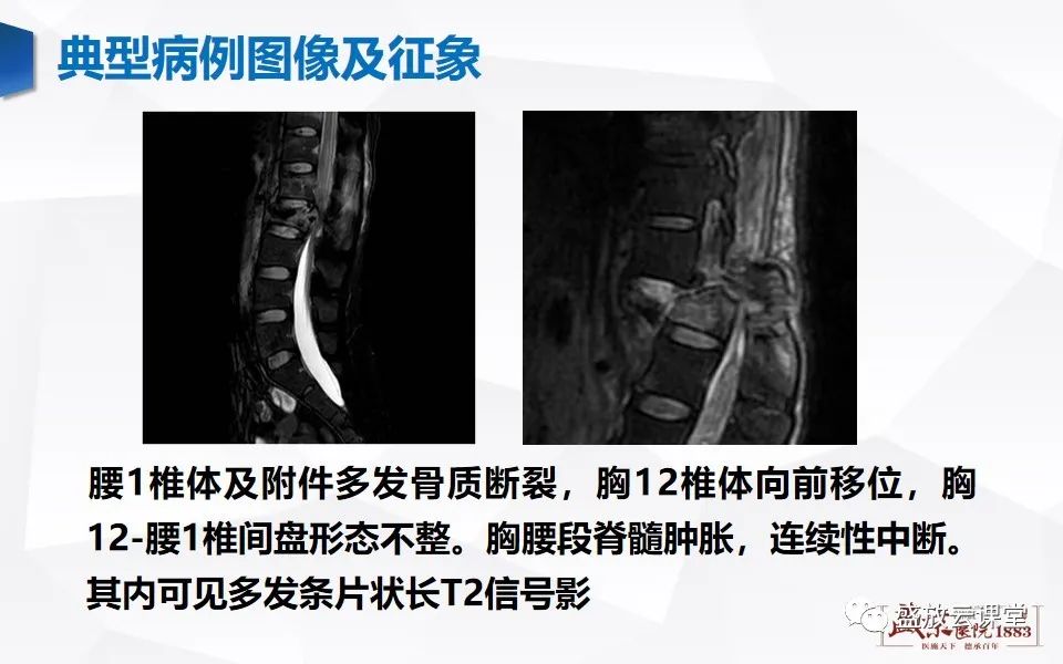 影像PPT - 【PPT】脊髓外伤-16