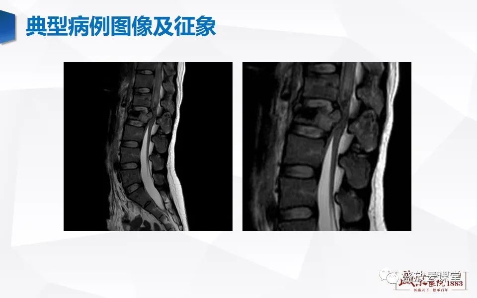 影像PPT - 【PPT】脊髓外伤-11