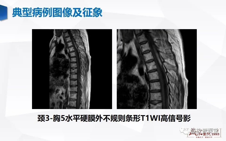 影像PPT - 【PPT】脊髓外伤-20