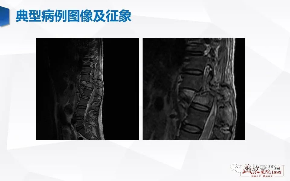 影像PPT - 【PPT】脊髓外伤-15