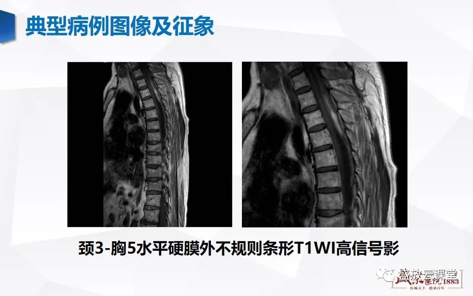 影像PPT - 【PPT】脊髓外伤-21