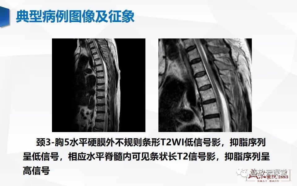 影像PPT - 【PPT】脊髓外伤-22