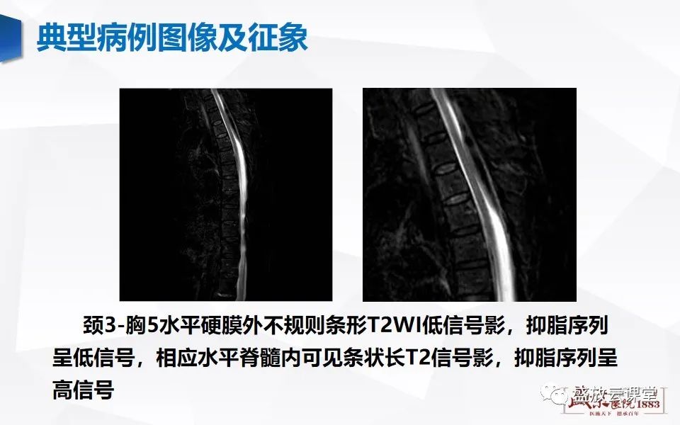 影像PPT - 【PPT】脊髓外伤-23