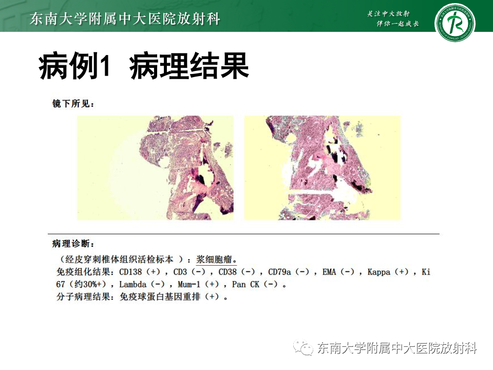 影像PPT - 【PPT】多发性骨髓瘤的影像诊断-6 影像PPT - 【PPT】多发性骨髓瘤的影像诊断-6