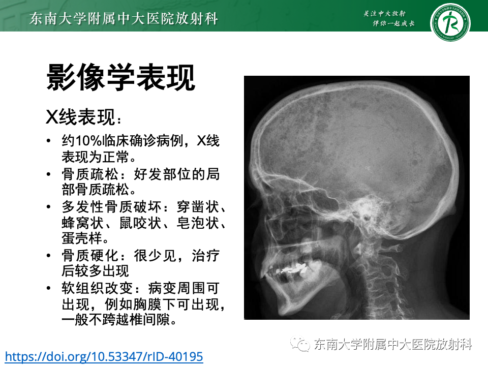 影像PPT - 【PPT】多发性骨髓瘤的影像诊断-13 影像PPT - 【PPT】多发性骨髓瘤的影像诊断-13