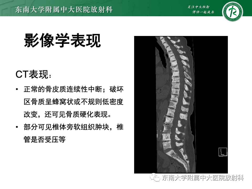影像PPT - 【PPT】多发性骨髓瘤的影像诊断-14 影像PPT - 【PPT】多发性骨髓瘤的影像诊断-14