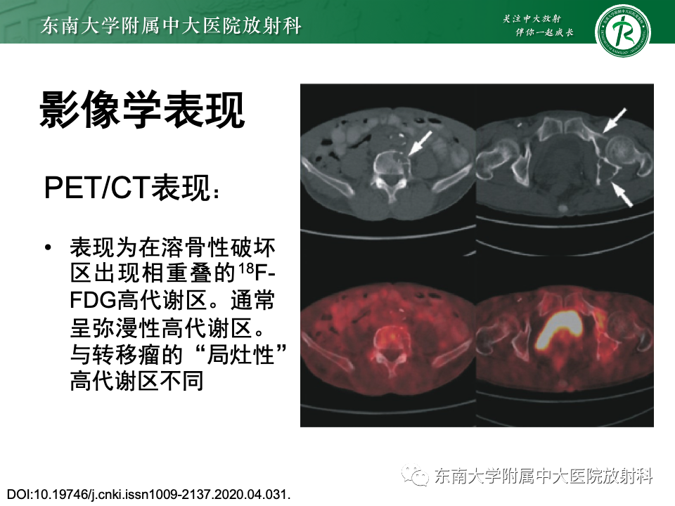 影像PPT - 【PPT】多发性骨髓瘤的影像诊断-16 影像PPT - 【PPT】多发性骨髓瘤的影像诊断-16