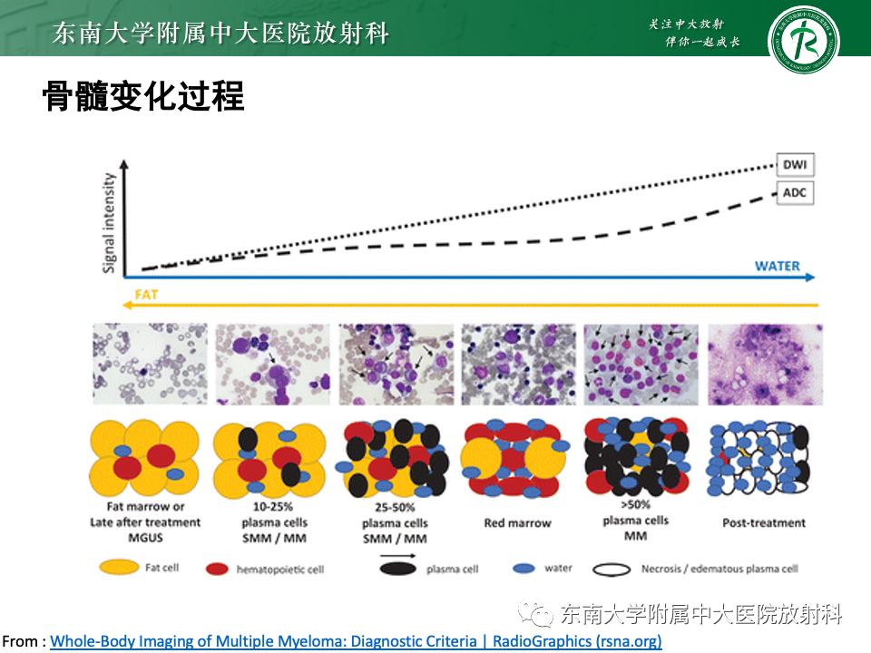 影像PPT - 【PPT】多发性骨髓瘤的影像诊断-20 影像PPT - 【PPT】多发性骨髓瘤的影像诊断-20