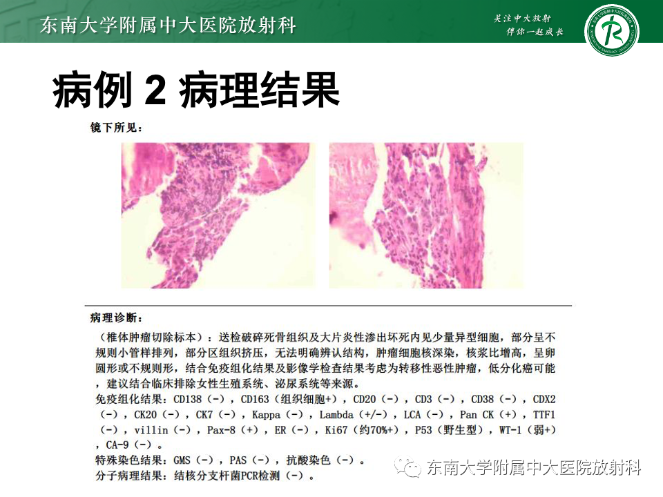 影像PPT - 【PPT】多发性骨髓瘤的影像诊断-21 影像PPT - 【PPT】多发性骨髓瘤的影像诊断-21
