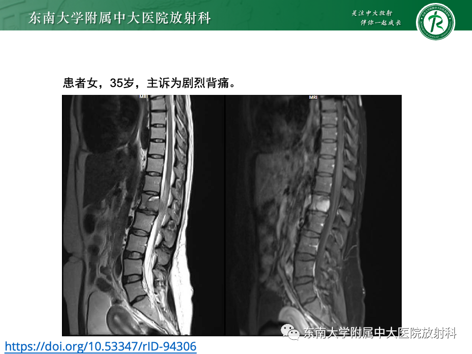 影像PPT - 【PPT】多发性骨髓瘤的影像诊断-27 影像PPT - 【PPT】多发性骨髓瘤的影像诊断-27